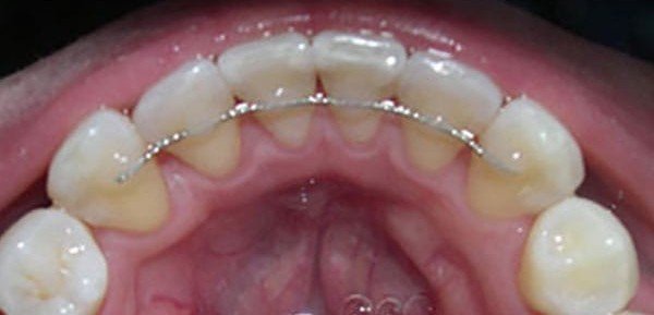 After orthodontic treatment at Bhati Dental Clinic